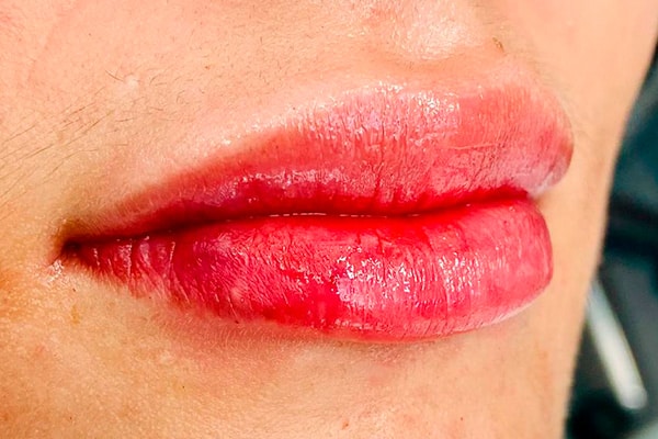 ácido hialurónico labios zaragoza